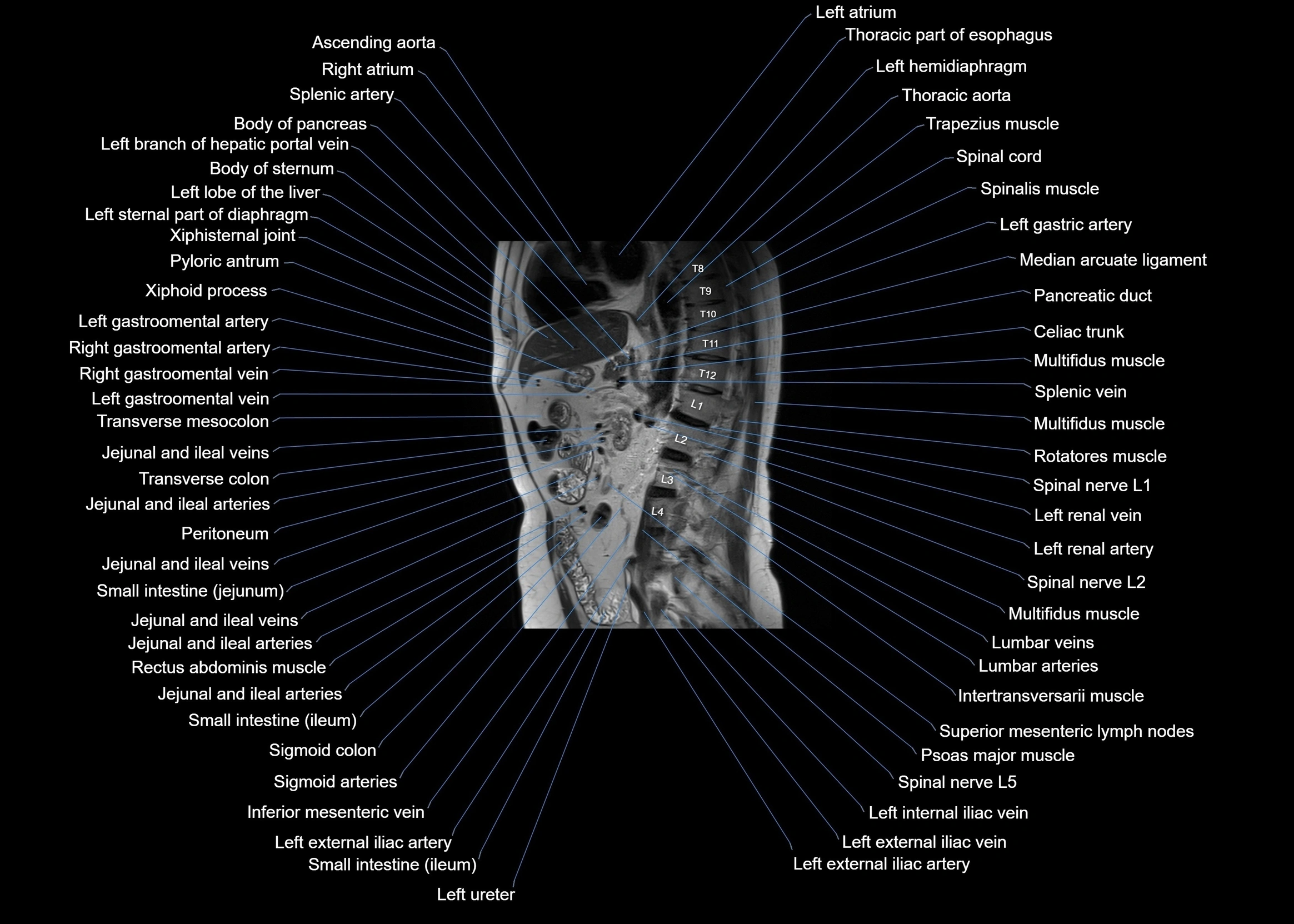 MRI abdomen sagittal cross sectional anatomy  radiology  image-img-00001-00040.webp